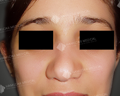 Rhinoplastie