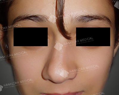 Rhinoplastie