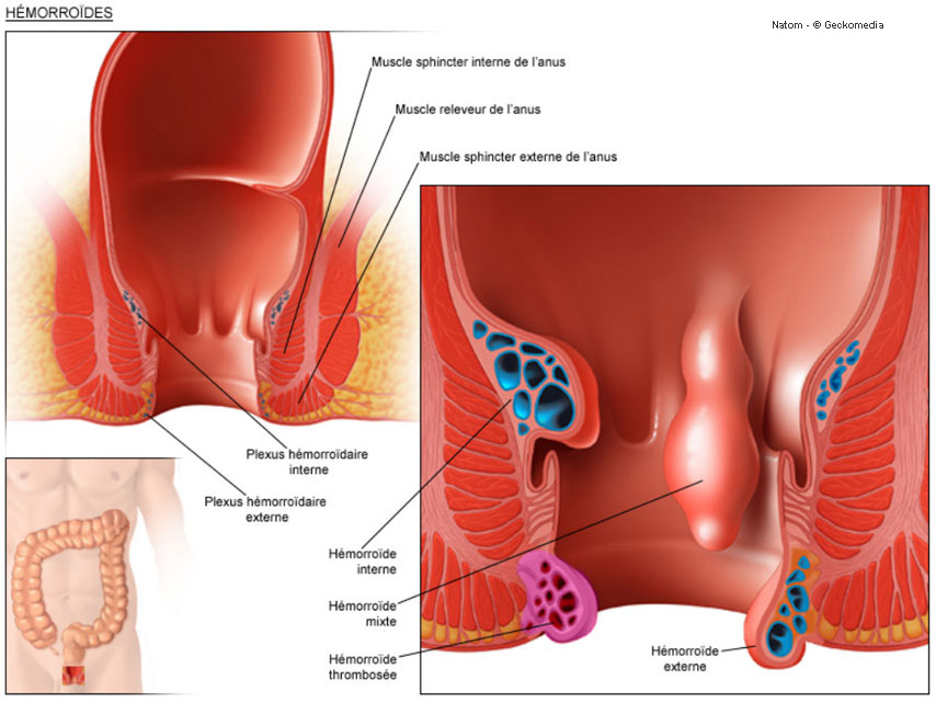 Polype anal