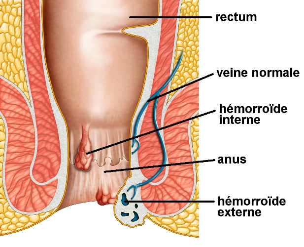 Proctolaser