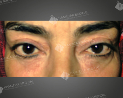 Blépharoplastie