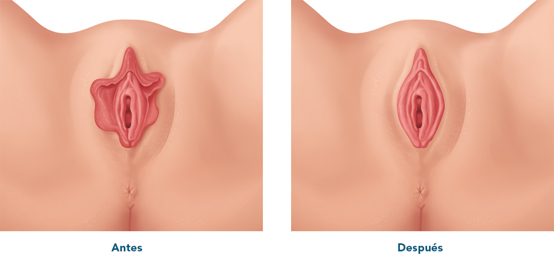 Reduction des lèvres vaginales