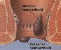 Hémorroïde Internes LHP