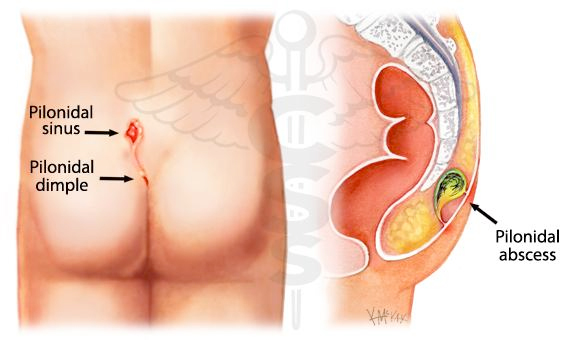 Sinus pilonidal