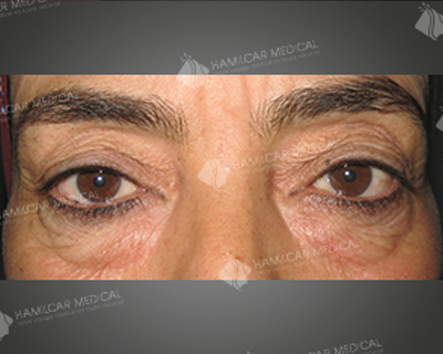 Blépharoplastie