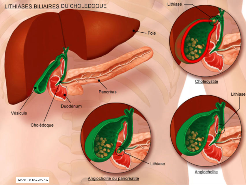 Voies biliaires - cholécystite aiguë