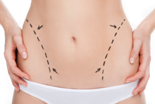 Abdominoplastie