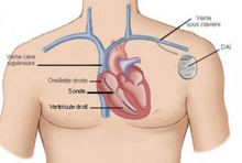 Défibrillateur automatique implantable