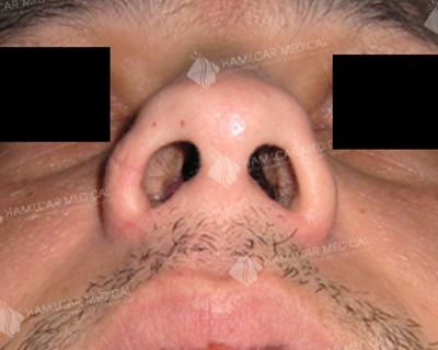 Rhinoplastie
