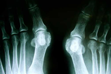 Hallux valgus