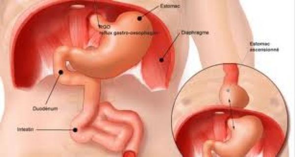 Oesophage - Nissen