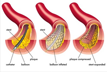 Dilatation coronaire