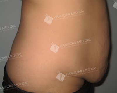 Abdominoplastie