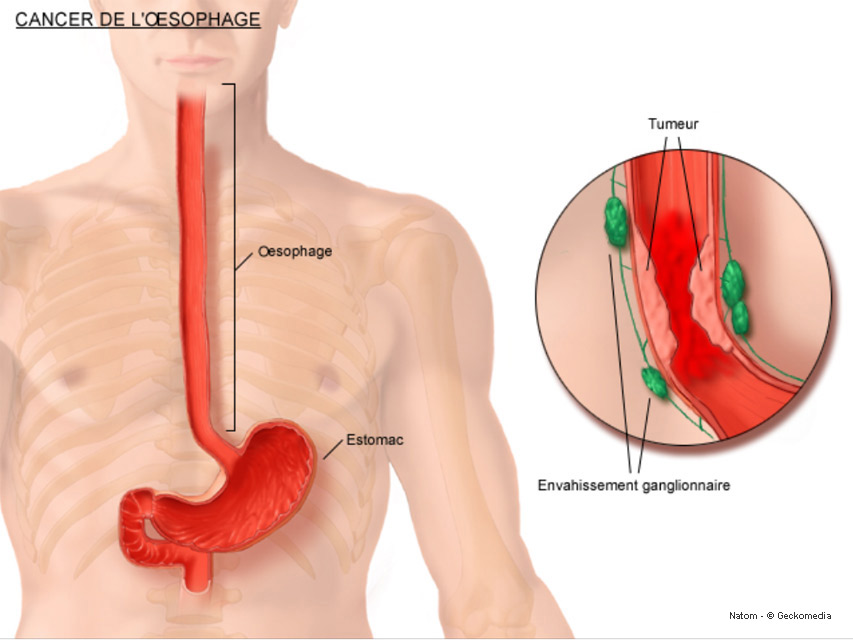 Oesophage - Achalasie