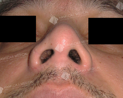 Rhinoplastie