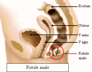 Fistule anale