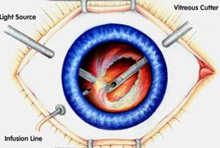 Vitrectomie